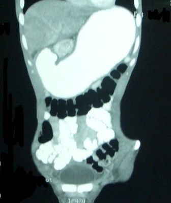 Figure 2: CT scan showing partial obstruction at the entropyloric region with distanded stomach and passage of contrast in small bowel.